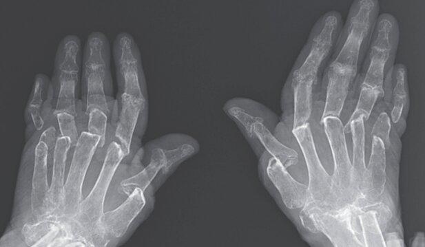 Caz medical ciudat: "Degetele telescop" i se micșorează din cauza unei afecțiuni rare