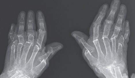 Caz medical ciudat: "Degetele telescop" i se micșorează din cauza unei afecțiuni rare