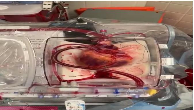 Doctorii au readus la viață o inimă moartă printr-o procedură inedită