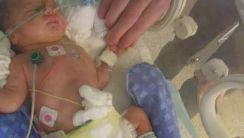 Născută prematur, complicații au provocat afecțiuni neurologice