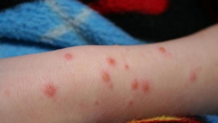 Rom&acirc;nia, la un pas de &icirc;ncă o epidemie! Peste 60 de cazuri de rujeolă, &icirc;nregistrate &icirc;n ultima săptăm&acirc;nă