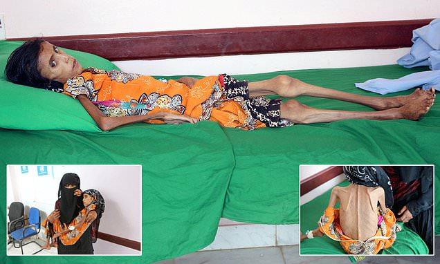 Cutremurător! O fetiță&nbsp;c&acirc;ntărește zece kilograme, la doar 12 ani! Sora micuței: &rdquo;Nu avem cu ce să o hrănim!&rdquo; Atenție, imagini care vă pot afecta emoțional!&nbsp;