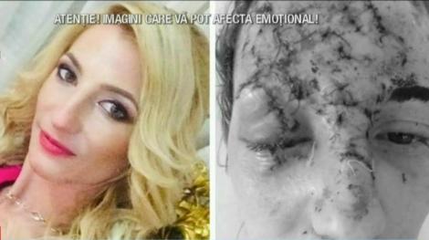 Dreptate pentru Ana, fata din Constanța, mutilată într-un accident rutier: "Fața mea e de monstru acum". Șoferul vinovat, șef de post, era băut