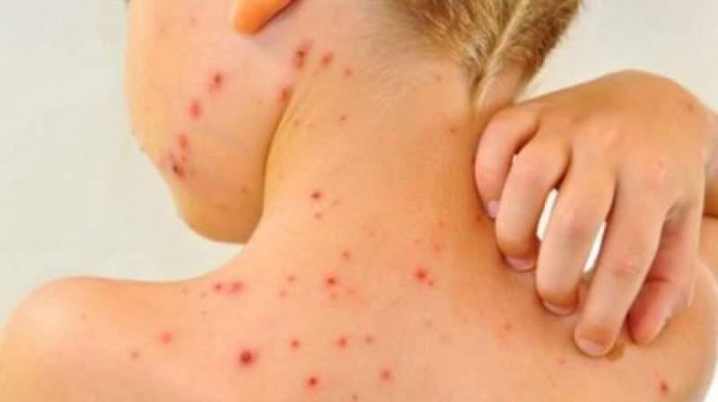 Epidemie de pojar &icirc;n SUA. Un comitat din statul New York le interzice minorilor nevaccinați accesul &icirc;n spațiile publice