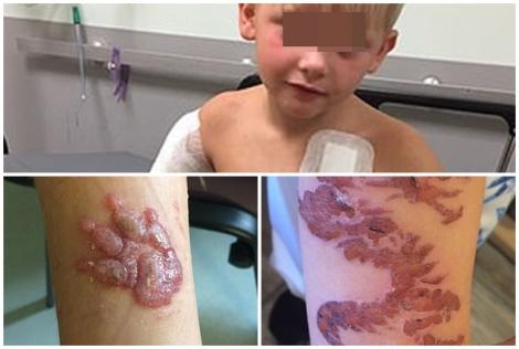 Băiețel de 7 ani cu arsuri grave din cauza unor tatuaje temporare cu henna: „Sunt disperată. Am crezut că e sigur”