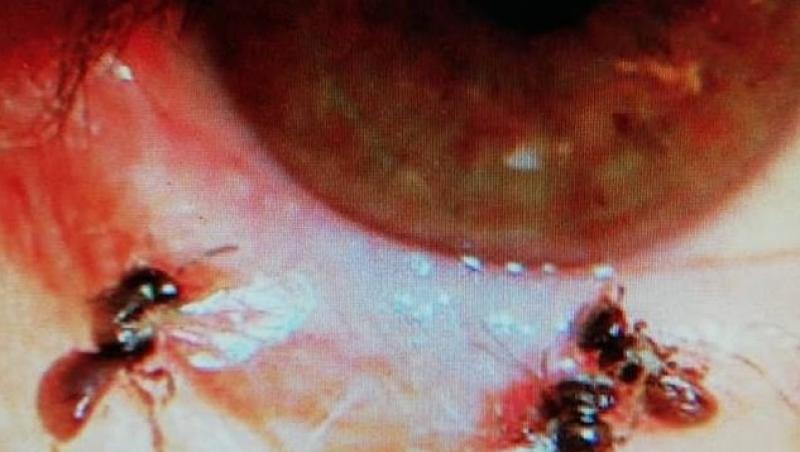 O femeie a ajuns de urgență la spital după ce a trăit ore în șir cu albine în ochi! Medic: ”Se hrăneau cu lacrimele ei!”