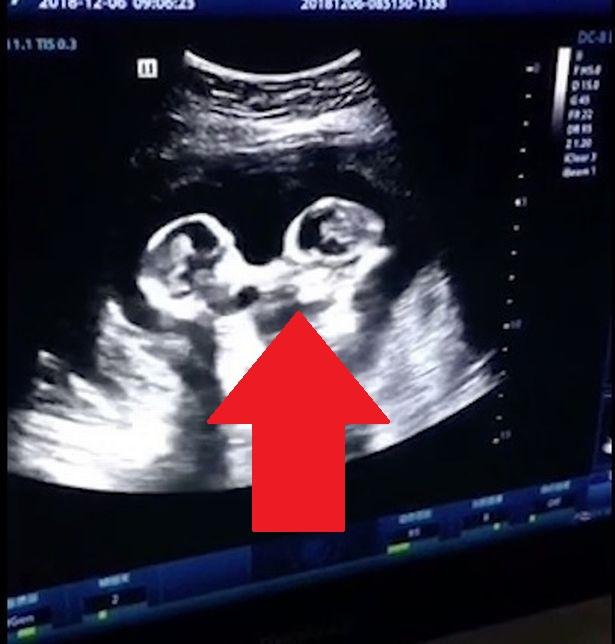 O femeie a făcut ecografie să vadă bebelușii, dar toți au amuțit! Ce se &icirc;nt&acirc;mpla &icirc;n burtă