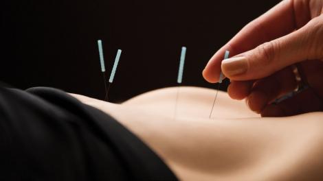 5 tratamente eficiente prin acupunctura