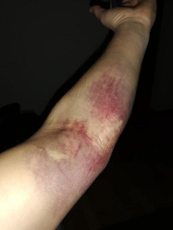 S-a dus să doneze s&acirc;nge și i-au măcelărit brațul: "Să vă luați o cremă de la farmacie!", i-a spus asistenta c&acirc;nd s-a pl&acirc;ns de durere