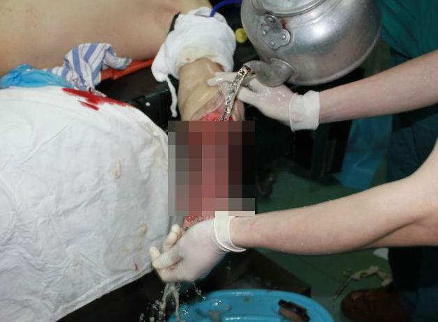 A ajuns la spital cu m&acirc;na &icirc;n sacoșă! Medicii i-au "lipit" brațul amputat bărbatului care a căzut de la etaj