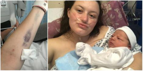 O mămică a făcut septicemie, din cauza unui obiect uitat de medici în corpul ei : „Când și-a dat seama ce era, a fost la un pas să leșine”