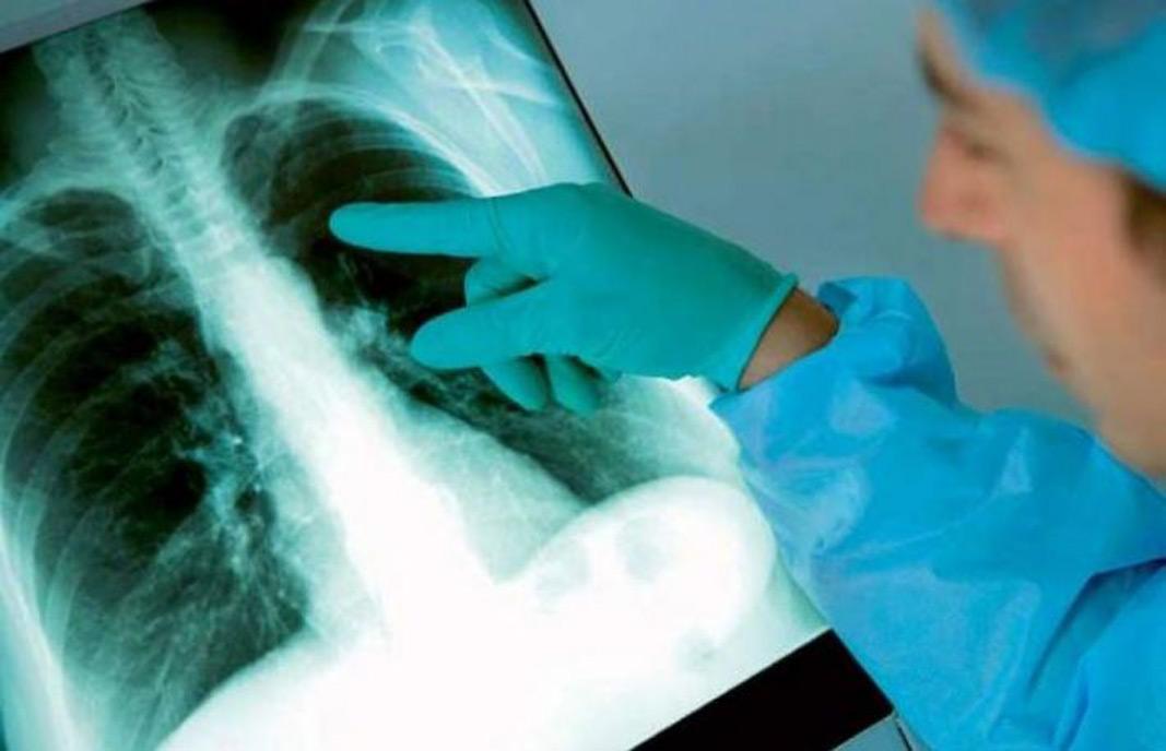 Două cazuri de tuberculoză, confirmate la o şcoală din Brăila! Au fost prelevate zeci de probe, iar cursurile ar putea fi suspendate