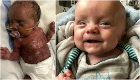 „Arăta ca o bucată de carne crudă”. Un bebeluș născut fără piele a uimit întreaga lume! Acum, la șase luni, zâmbește și topește inimi – Foto