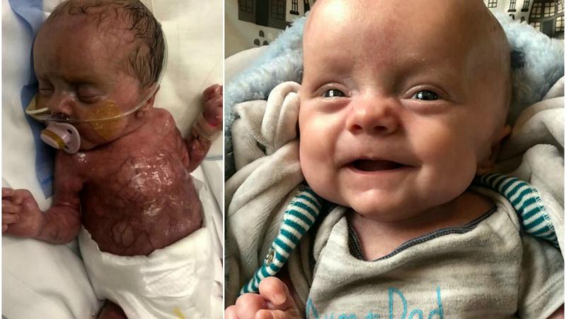 „Arăta ca o bucată de carne crudă”. Un bebeluș născut fără piele a uimit întreaga lume! Acum, la șase luni, zâmbește și topește inimi – Foto