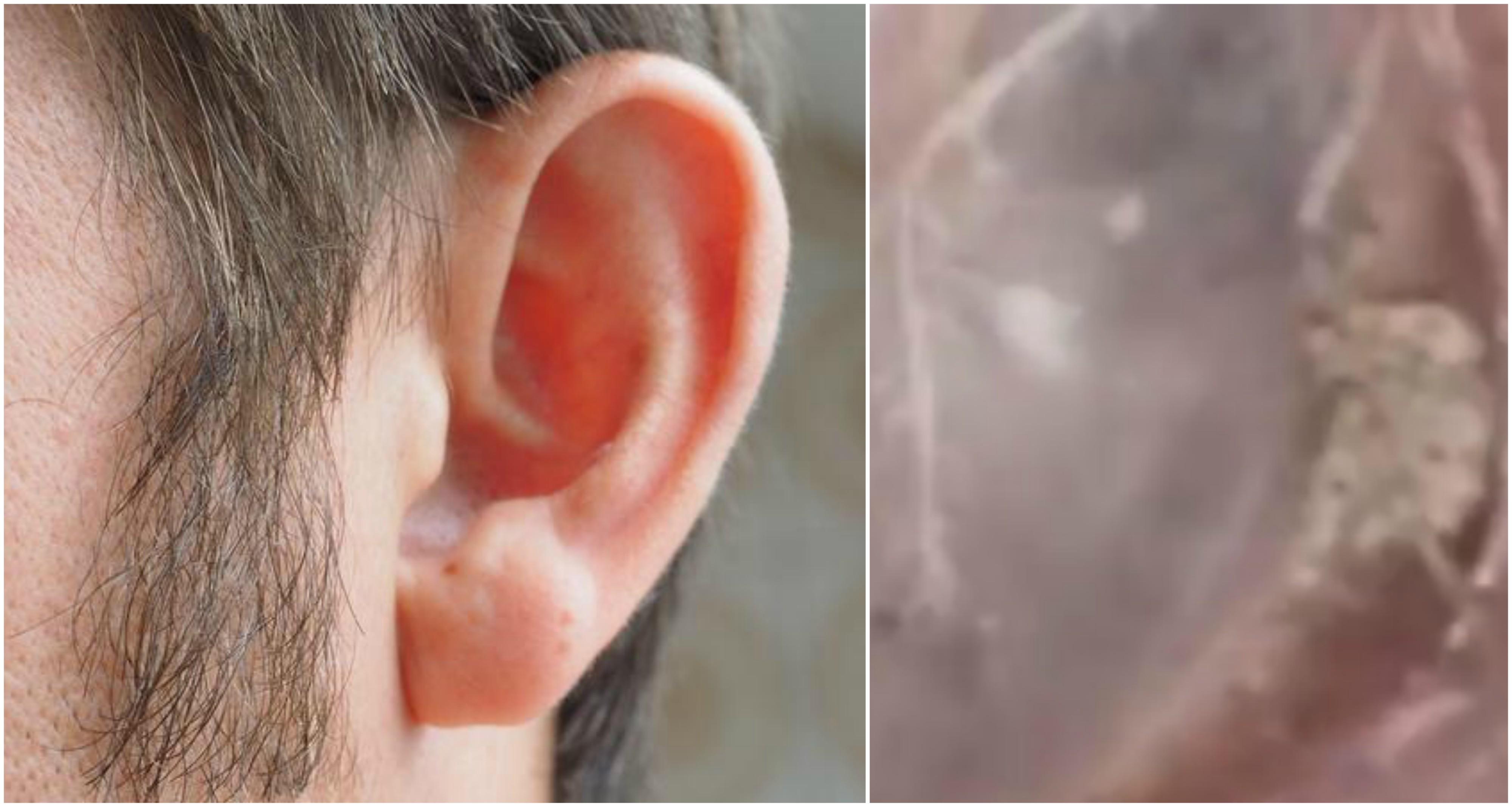 S-a dus la doctor cu o senzație ciudată &icirc;n ureche și a trăit un șoc! Ce a descoperit medicul.&nbsp;Video