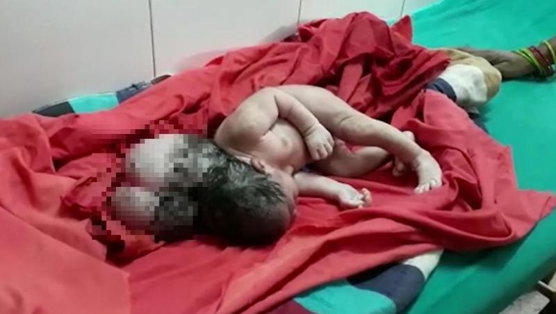 Un bebeluș s-a născut cu trei capete! Familia lui este în stare de șoc! „Arată ca un extraterestru”. Imagini tulburătoare!
