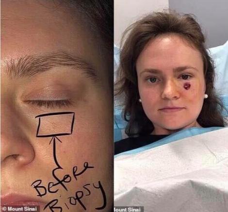 O femeie a rămas șocată după ce a aflat că iritația pe care o avea sub ochiul stâng s-a transformat în cancer de piele. Cauza ar fi radiațiile solare