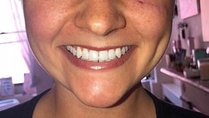 O femeie a rămas șocată după ce a aflat că iritația pe care o avea sub ochiul stâng s-a transformat în cancer de piele. Cauza ar fi radiațiile solare