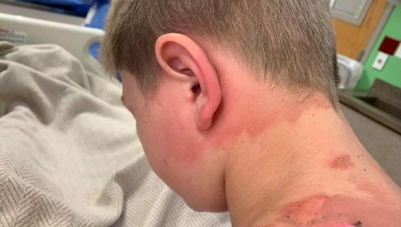 Atenție, părinți! O provocare online periculoasă, populară în rândul copiilor! Un băiat de 11 ani a ajuns la spital cu arsuri grave! Imagini tulburătoare! Foto