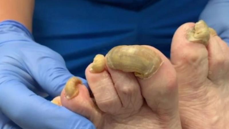 O femeie nu și-a mai tăiat unghia timp de un an, din cauza unei ciuperci! Medicii s-au îngrozit de rezultat
