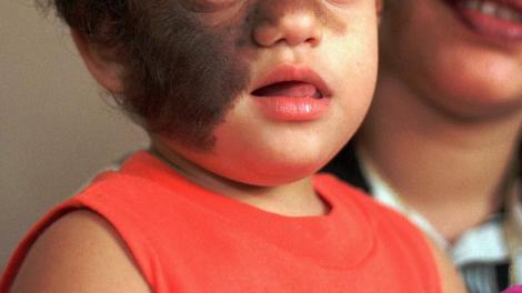Copii cu „sindromul vârcolacului”, după un medicament primit în spital! Părinții sunt șocați de cum arată