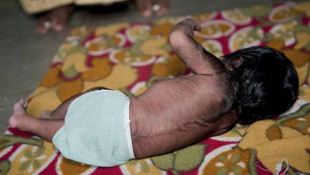 Nou-născuți transformați &icirc;n v&acirc;rcolaci după naștere: "Copilul meu se tot umplea de păr. M-am &icirc;ngrozit!"