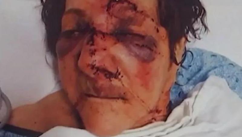O femeie în vârstă de 86 de ani a fost maltratată de îngrijitoarele de la centru: „Are fracturi duble la nivelul feței, nasul rupt și e cusută pe toată fața”