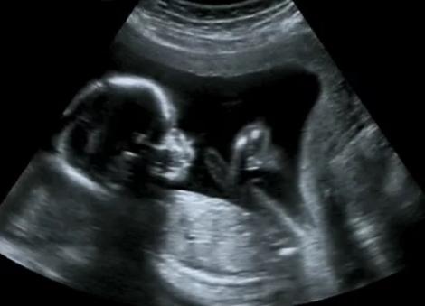 O gravidă a mers să facă ecografie, dar a trăit un șoc uriaș! Ce imagine sinistră a apărut | FOTO