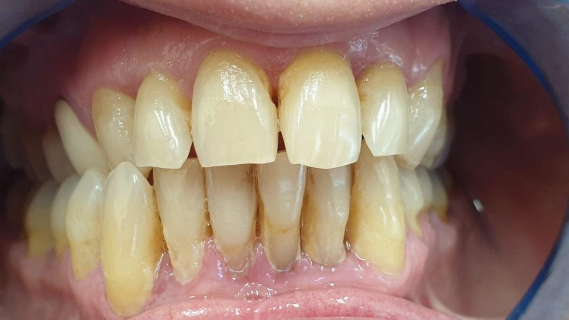 8 din 10 romani suferă de parodontoză! Life Dental Spa trage un semnal de alarmă