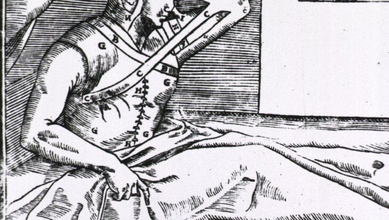 Tehnica „nasului de pe braț”, perioada Renașterii