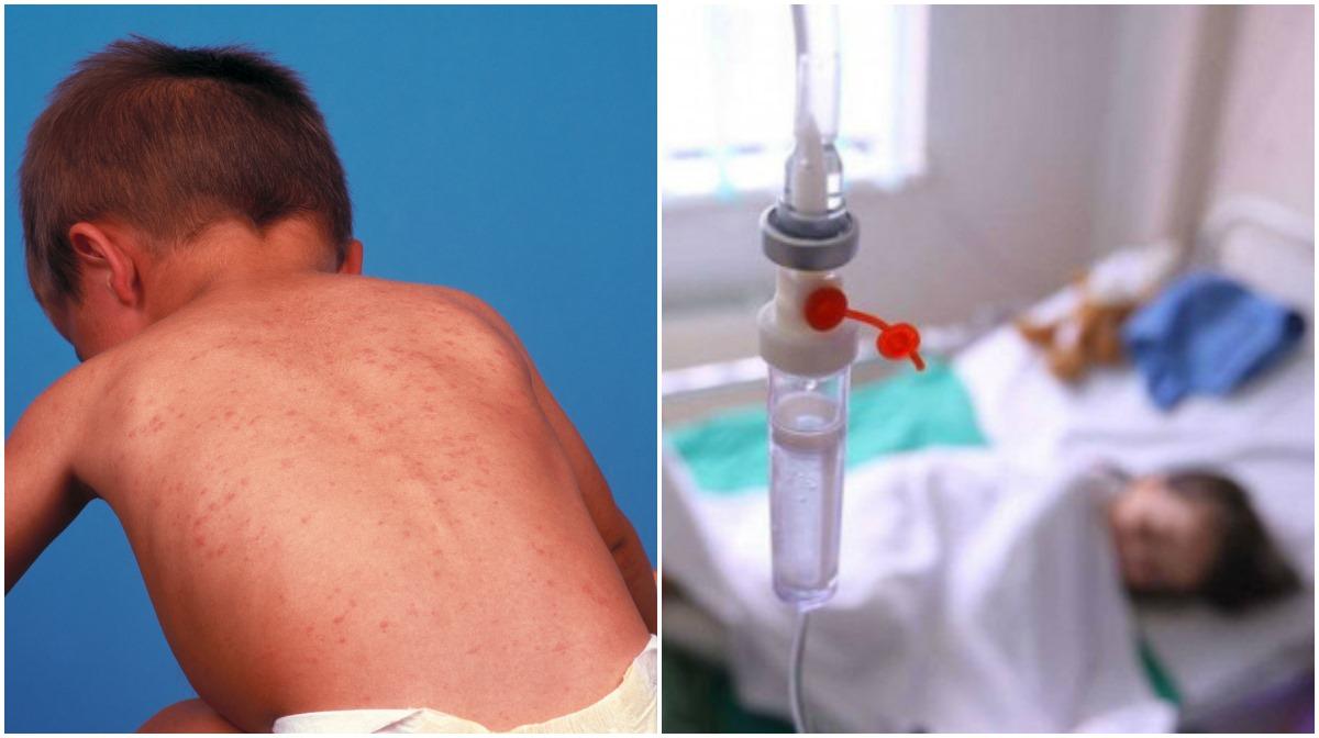 Zeci de cazuri de rujeolă confirmate &icirc;n Rom&acirc;nia. Care sunt județele afectate