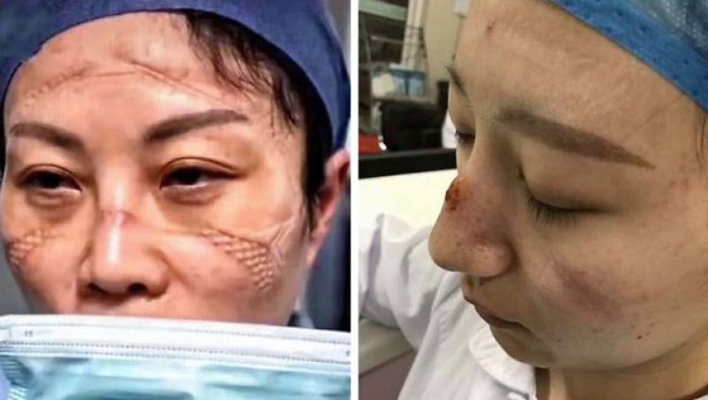 Medicii din China sunt desfigurați din cauza costumelor de protecție