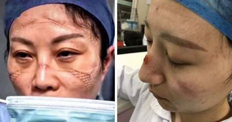 Imagini teribile din China. Medicii care tratează pacienții cu coronavirus sunt desfigurați din cauza echipamentelor
