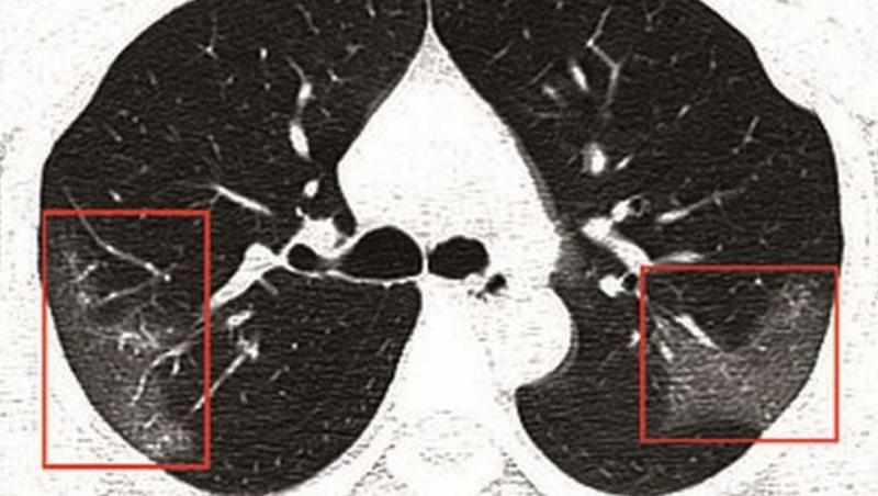 Radiografia arată efectele COVID-19 în organismul unei tinere de 33 de ani