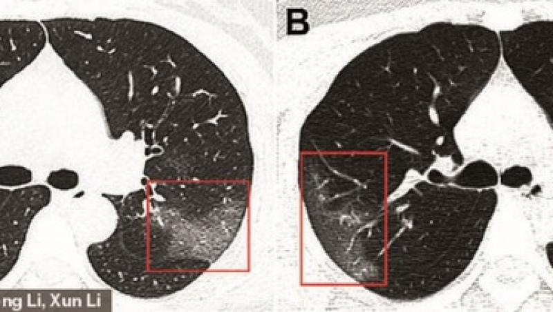 Radiografia arată efectele COVID-19 în organismul unei tinere de 33 de ani