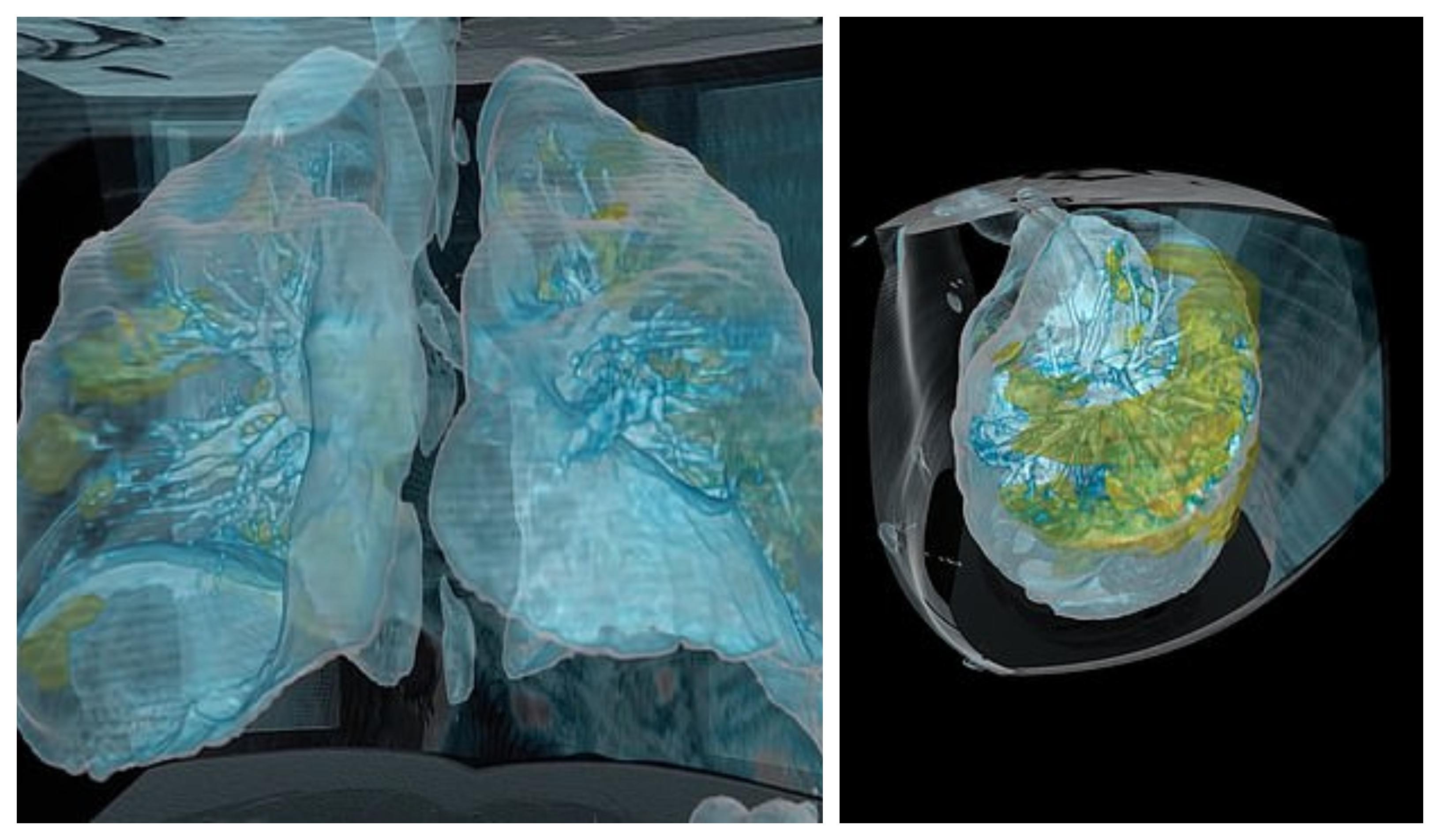 Ai curaj să privești? Cum distruge noul coronavirus plăm&acirc;nii celor infectați! Cele mai detaliate imagini, &icirc;n realitate virtuală! VIDEO