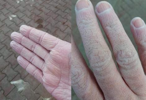 Așa arată mâinile cadrelor medicale din Suceava, după 12 ore de muncă! „Purtăm trei rânduri de mănuși. Picioarele nu le arăt, că mi-e rușine”