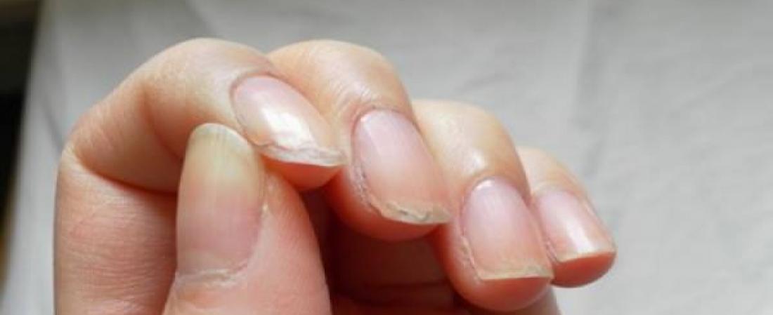 Cum să scăpați de unghiile exfoliate, crăpate sau fragile. Care sunt cauzele și ce puteți face pentru a nu mai avea aceste probleme