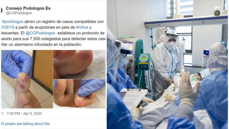 Un nou simptom al coronavirusului atacă pacienții! Pare că le-au degerat picioarele, sunt roșii și tumefiate: „acestea sunt leziuni purpurii"
