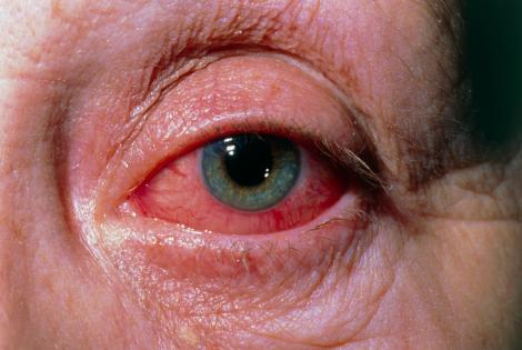 Descoperire uluitoare în ochii celor infectați cu noul coronavirus. Medicii italieni au făcut totul public: „Ce vedeți aici este la 21 de zile după apariția primelor simptome”