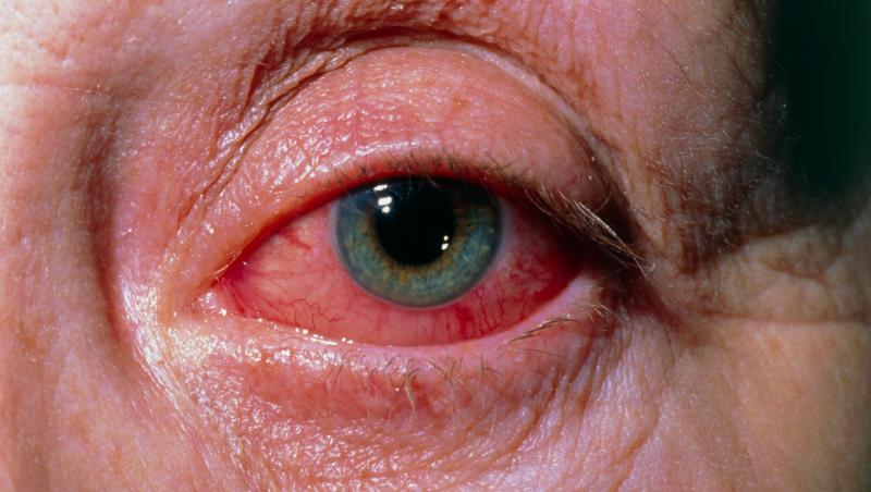 Descoperire uluitoare în ochii celor infectați cu noul coronavirus