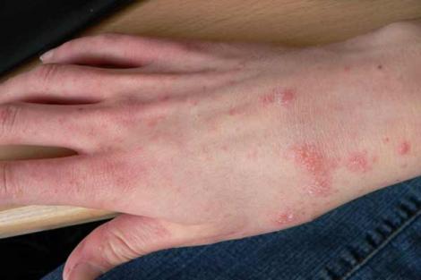 Dezinfectanții și mănușile din latex pot provoca alergii și iritații puternice. Care sunt primele simptome ale unor dereglări ale pielii