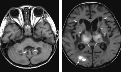 O nouă descoperire terifiantă despre COVID-19! Cum distruge creierul pacienților. Atenție, imagini cu un puternic impact emoțional! - FOTO