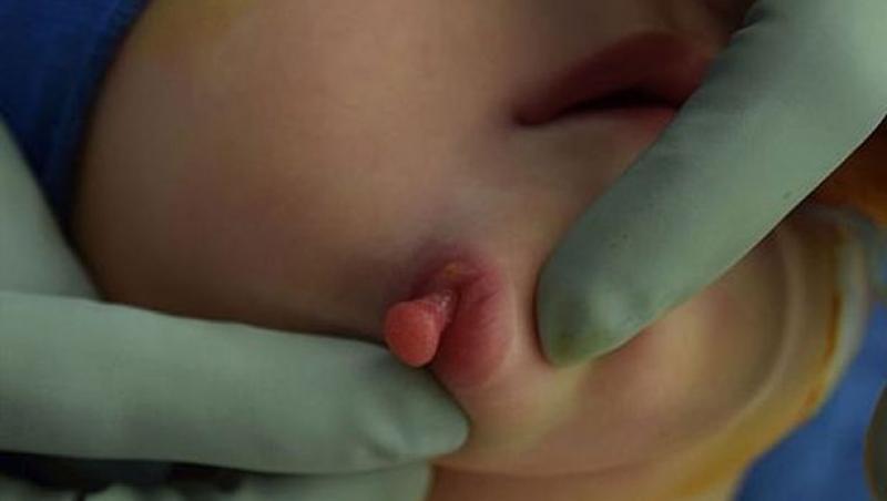 Bebelușa care i-a lăsat muți pe medici. Ce avea fetița pe obraz, la naștere: „Există doar 35 de cazuri, în istorie!” - FOTO