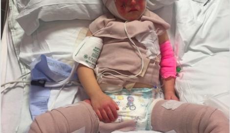 Incident înfiorător în Bistrița! Copil de doi ani opărit cu lapte: Are arsuri grave pe față, mâini și burtă