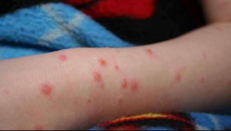 Statistici &icirc;ngrijorătoare! Numărul cazurilor de rujeolă a crescut &icirc;n ultima săptăm&acirc;nă