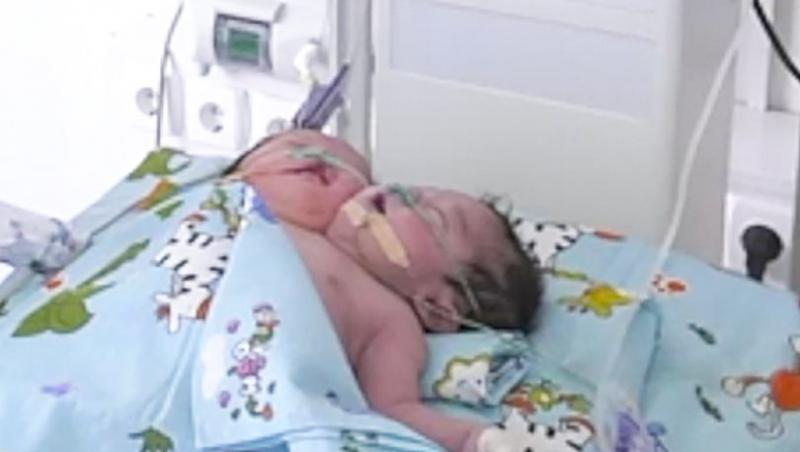 O tânără a născut un bebeluș cu două capete. Medicii sunt uluiți: „E ca și cum ai înghesui două persoane într-un singur corp”