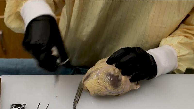 Cum arată inima unui om care a murit de COVID-19. Medic: „Are margini dilatate”. Atenție, imagini ce vă pot afecta emoțional!  VIDEO