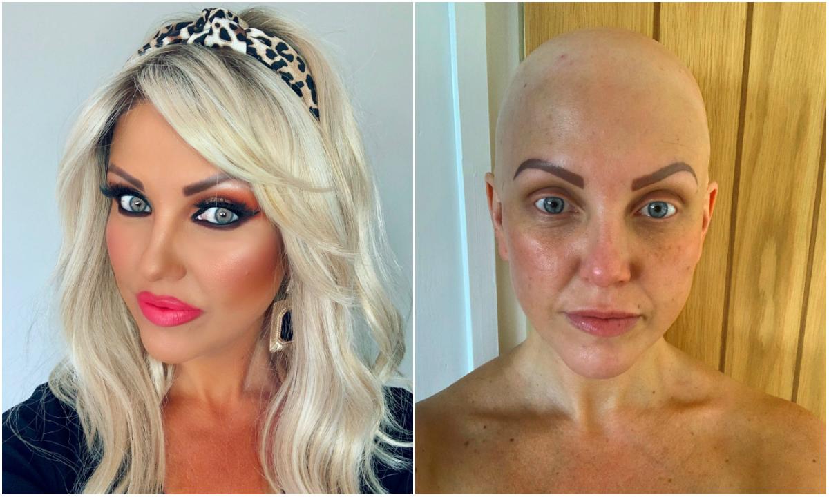 &bdquo;&Icirc;mi pierdusem feminitatea, frumusețea&rdquo; O femeie și-a pierdut tot părul, &icirc;n c&acirc;teva zile: &bdquo;Mă &icirc;ntrebam ce făcusem să merit așa ceva&rdquo;