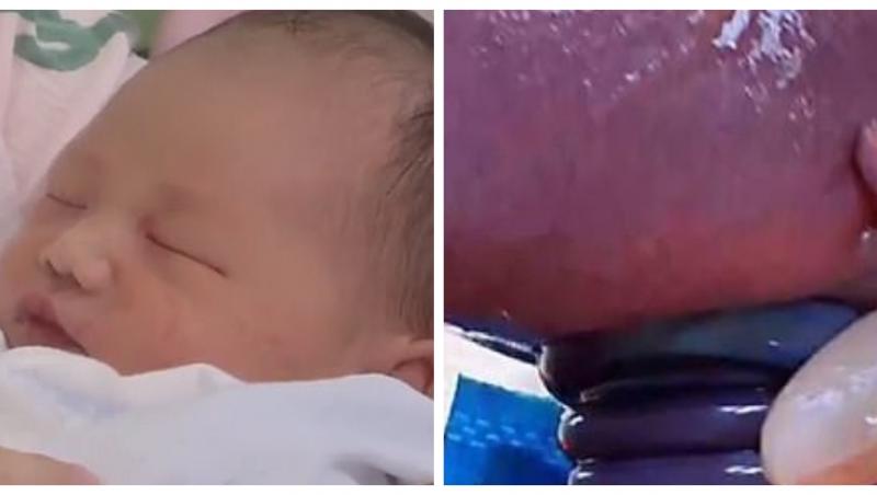 Un bebeluș s-a născut perfect sănătos, deși avea cordonul ombilical răsucit în jurul gâtului de șase ori: ”E un miracol. N-am văzut așa ceva în 23 de ani de carieră!”